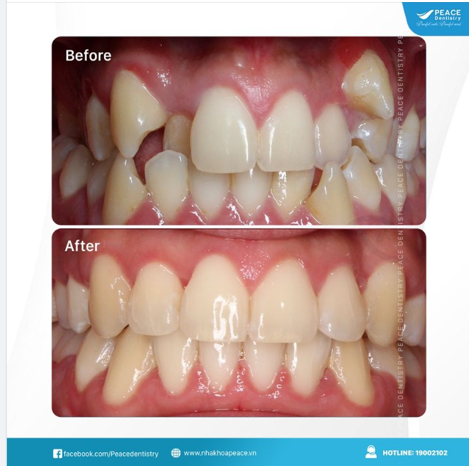 Ca lâm sàng: Niềng răng mắc cài tự đóng cho khách hàng nam 20 tuổi