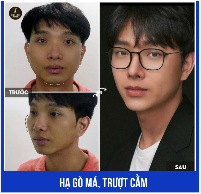 VỤT SÁNG NHƯ IDOL K-POP VỚI COMBO HẠ GÒ MÁ, TRƯỢT CẰM