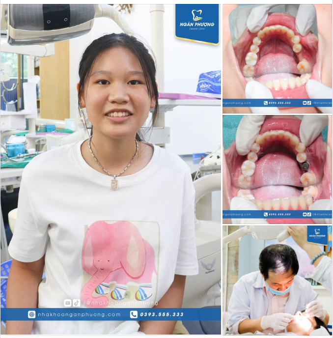 Cảm ơn Quỳnh Nga đã tin tưởng bác sĩ Giang và Nha khoa Ngân Phượng. Hẹn Nga 4 - 6 tháng tới để phục hình mão sứ nhé