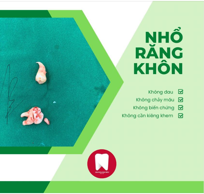 NHỔ RĂNG KHÔN MỌC LỆCH BẰNG MÁY SIÊU ÂM PIEZOTOME