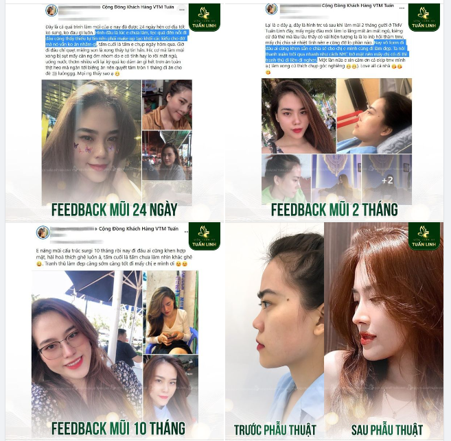 Feedback Nâng mũi cực chi tiết và siêu có tâm của bạn khách hàng 9X nhà Tuấn Linh.