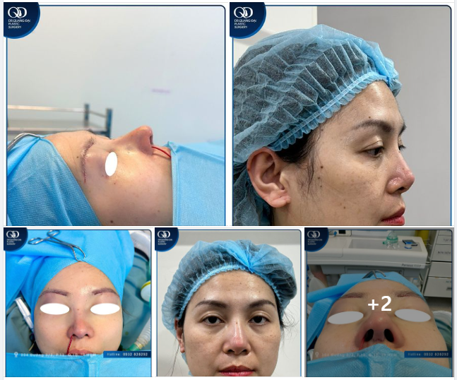 KẾT QUẢ LÀM ĐẸP SIÊU ƯNG Ý CỦA CHỊ KHÁCH HÀNG VIỆT KIỀU PHÁP
