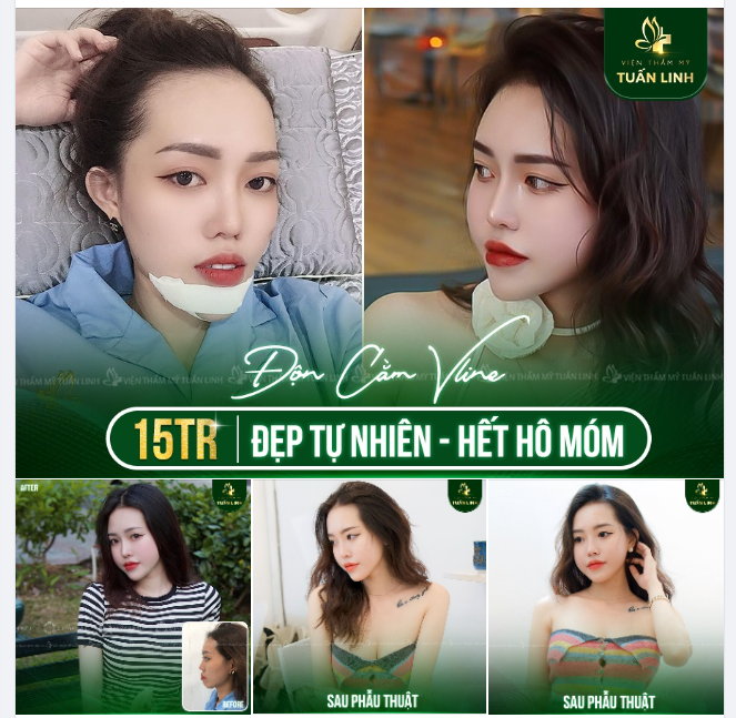 Chỉ 15TR sở hữu ngay cằm Vline đẹp tự nhiên, hết hô móm