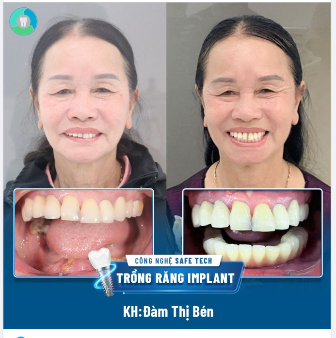 TRỒNG RĂNG IMPLANT TOÀN HÀM DƯỚI - KHÔI PHỤC KHẢ NĂNG ĂN NHAI