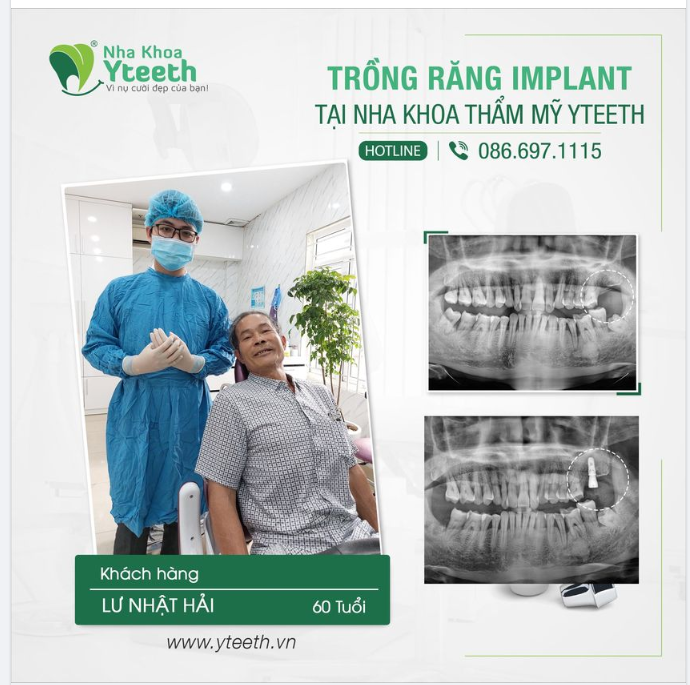 Vì sao nên cấy ghép Implant thay vì làm cầu răng?