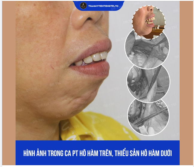 HÌNH ẢNH CA PHẪU THUẬT HÔ HÀM TRÊN - THIỂU SẢN XƯƠNG HÀM DƯỚI