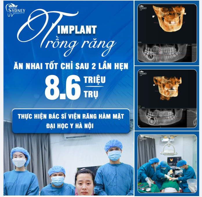 TRỒNG RĂNG IMPLANT MẤT BAO LÂU?