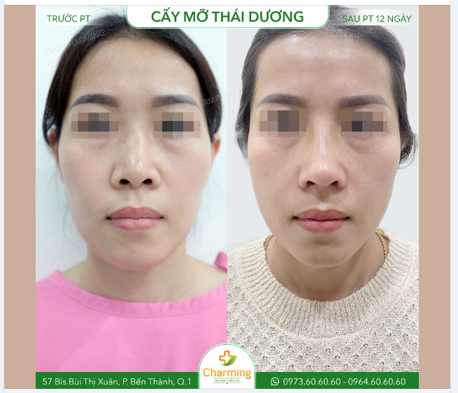 Khuôn mặt phúc hậu, hiền hòa hơn nhờ phẫu thuật cấy mỡ thái dương là đây.