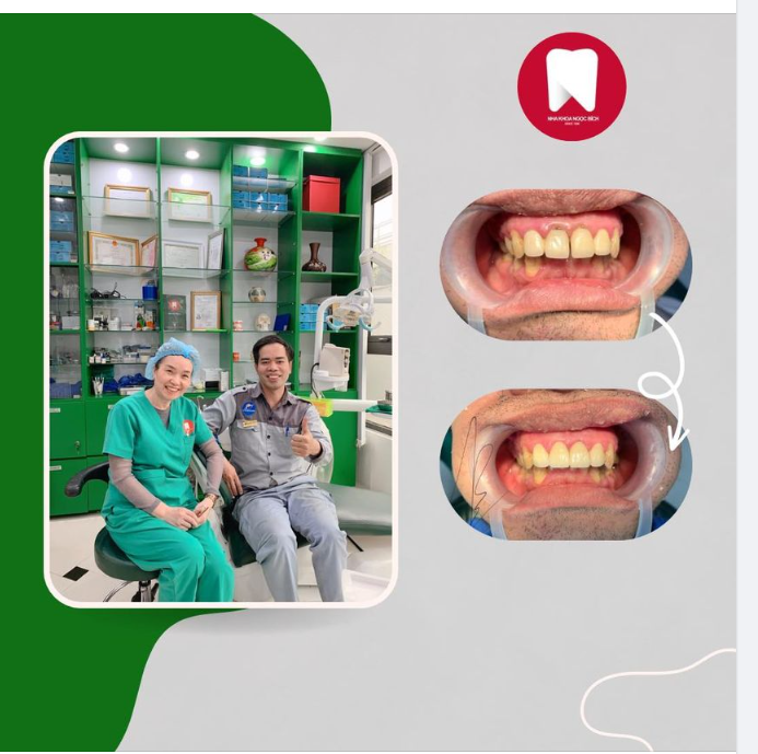 Giải cứu răng sứ cũ hỏng, tái sinh nụ cười sau 2 lần hẹn
