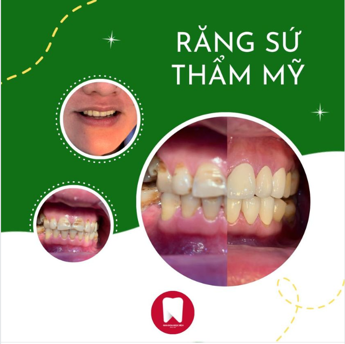 PHÁI NAM CÓ NÊN BỌC RĂNG SỨ?
