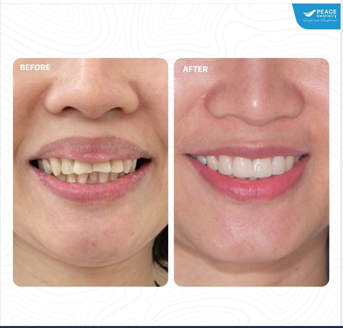 CÂU CHUYỆN VỀ 4 MẶT SỨ VENEER ĐẾN NỤ CƯỜI TỰ NHIÊN.