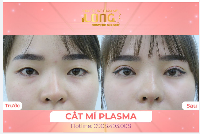 TẠI SAO CẮT MÍ MẮT PHẢI TÌM ĐẾN PTTM BÁC SĨ LONG, MÀ KHÔNG PHẢI LÀ NƠI KHÁC?