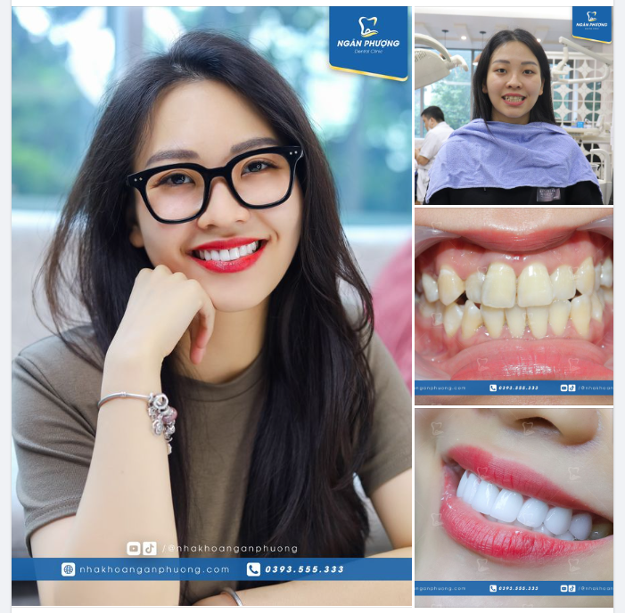 Bí quyết nào giúp Nhật Lệ hô biến nhan sắc mà vẫn bảo tồn được răng, giữ răng miệng khỏe mạnh?