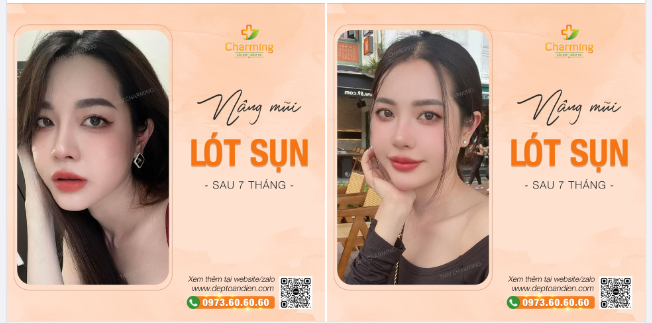 Môi em đỏ thắm, xinh tươi. Mũi em lót sụn, người người đều khen