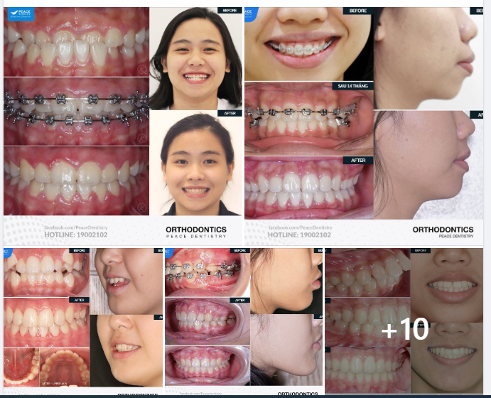 TỔNG HỢP MỘT SỐ CA LÂM SÀNG NIỀNG RĂNG TIÊU BIỂU TẠI PEACE DENTISTRY