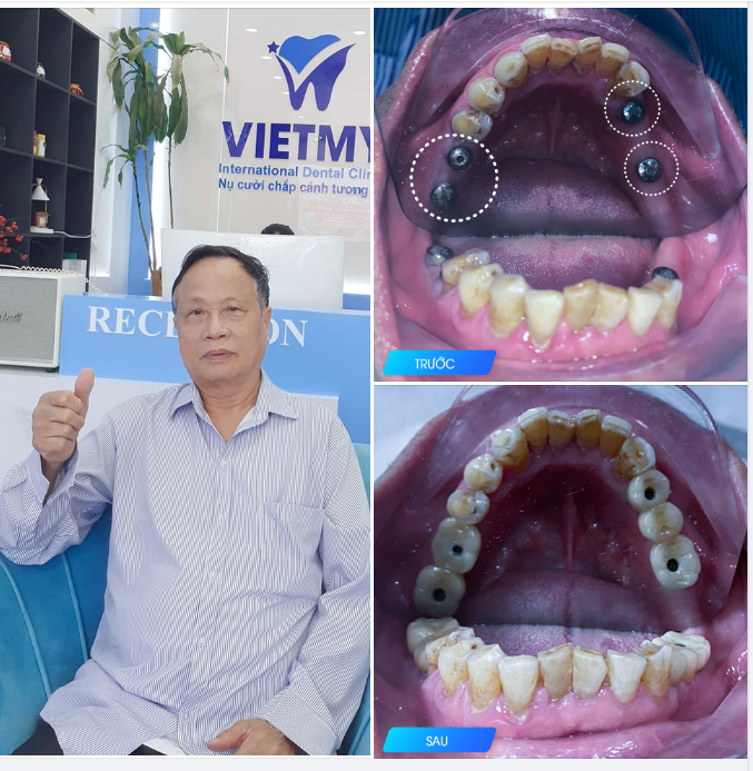Khách hàng Bùi Đăng Hùng (75 tuổi) đến với Nha khoa Quốc Tế Việt Mỹ