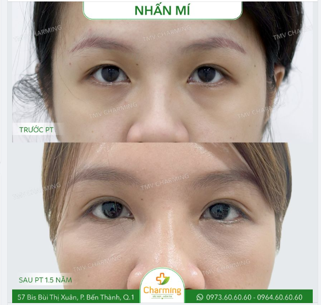 Đôi mí của người trẻ nhưng cũng có lắm vấn đề.