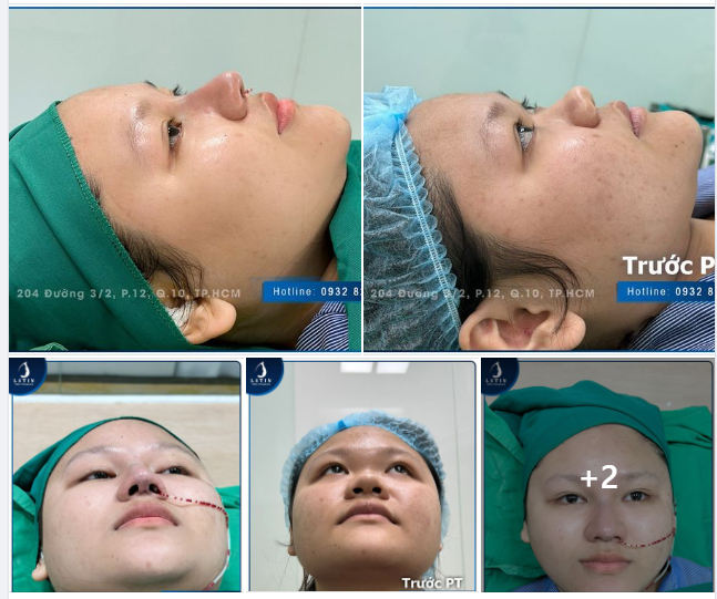 Phương pháp nâng mũi phù hợp cho khách hàng không có xương chính mũi