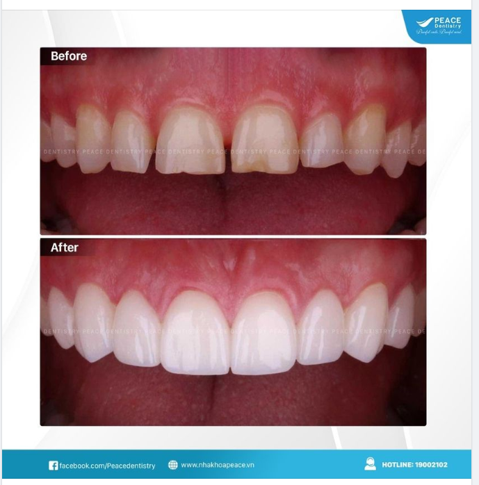 MẶT DÁN SỨ VENEER - BIẾN ĐỔI NỤ CƯỜI XINH TƯƠI, BẢO TỒN RĂNG THẬT TỐI ĐA