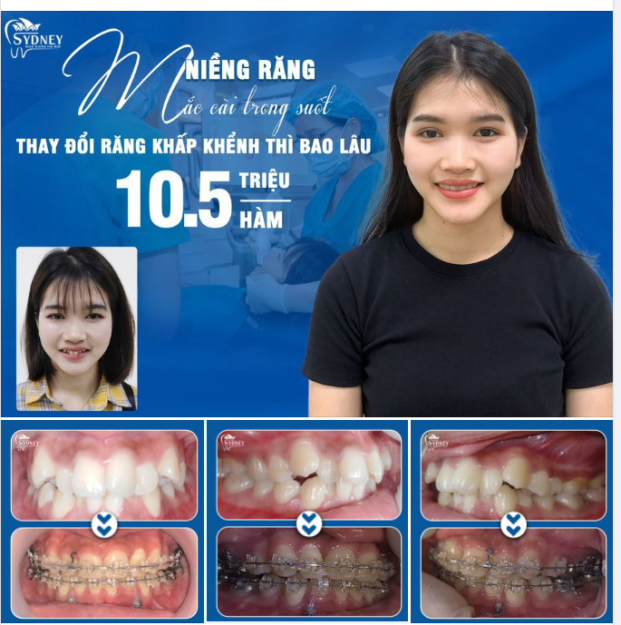 NIỀNG RĂNG BAO LÂU THAY ĐỔI RĂNG KHẤP KHỂNH?
