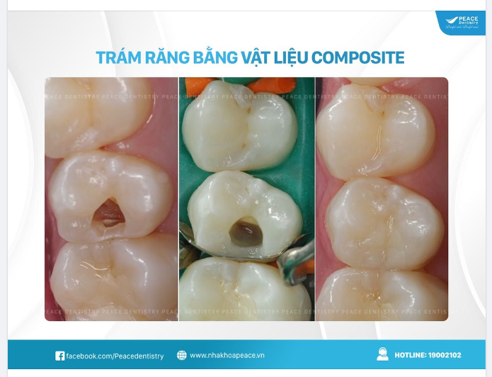 TRÁM RĂNG KHÔNG CHỈ ĐƠN THUẦN LÀ LẤP ĐẦY