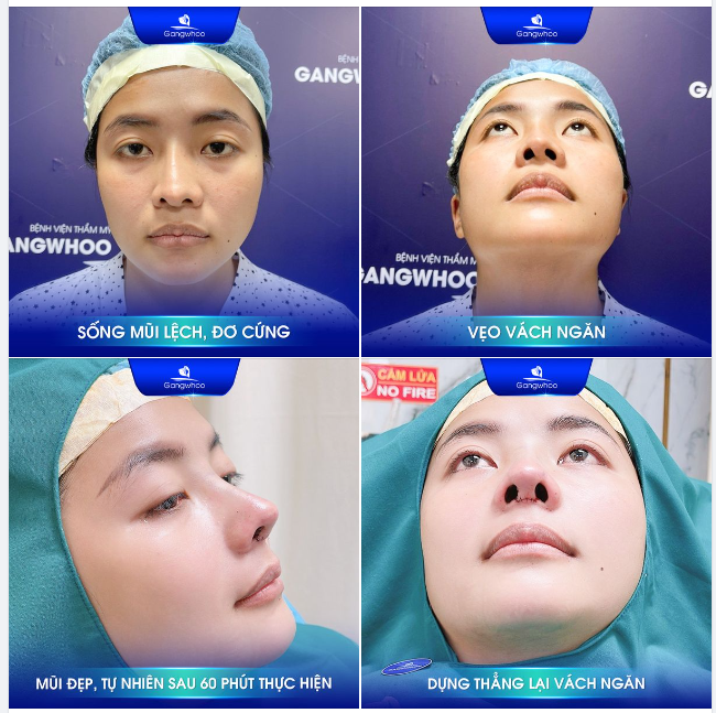 MŨI HỎNG NÊN SỬA LẠI BẰNG PHƯƠNG PHÁP NÀO?