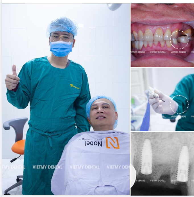 Trồng lại răng implant cho anh Nguyễn Văn Hưng - sinh sống tại Hai Bà Trưng - Hà Nội.