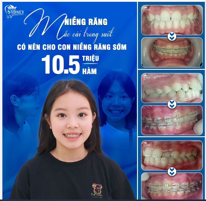 THAY ĐỔI NỤ CƯỜI CHO CON VỚI NIỀNG RĂNG CHỈ VỚI 10,5 TRIỆU/HÀM