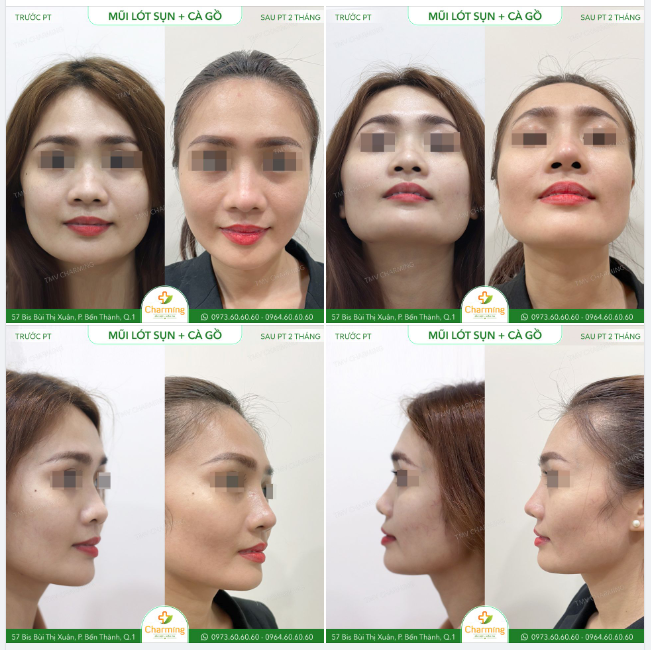Nâng mũi mà không chú ý đến gồ mũi cũng là một điều đáng ngại.
