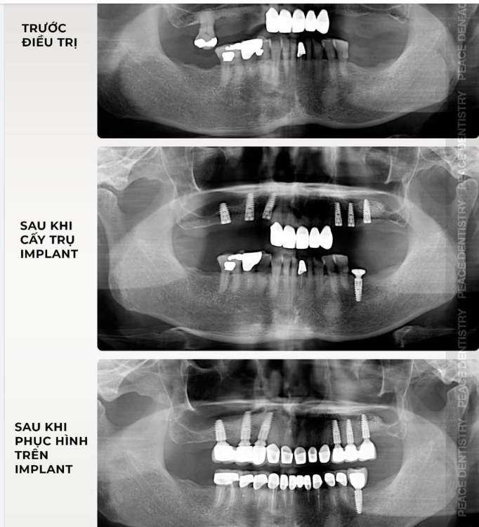 TÌM LẠI NỤ CƯỜI TUỔI XẾ CHIỀU