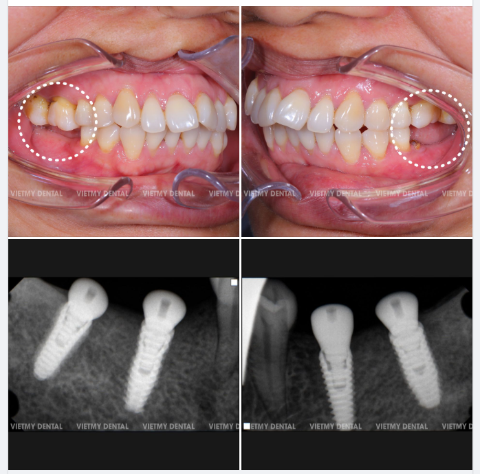 Chị Vân (45 tuổi) đến với Nha khoa Quốc Tế Việt Mỹ trong tình trạng mất toàn bộ răng hàm- hàm dưới, không còn khả năng ăn nhai, chỉ ăn được đồ mềm.