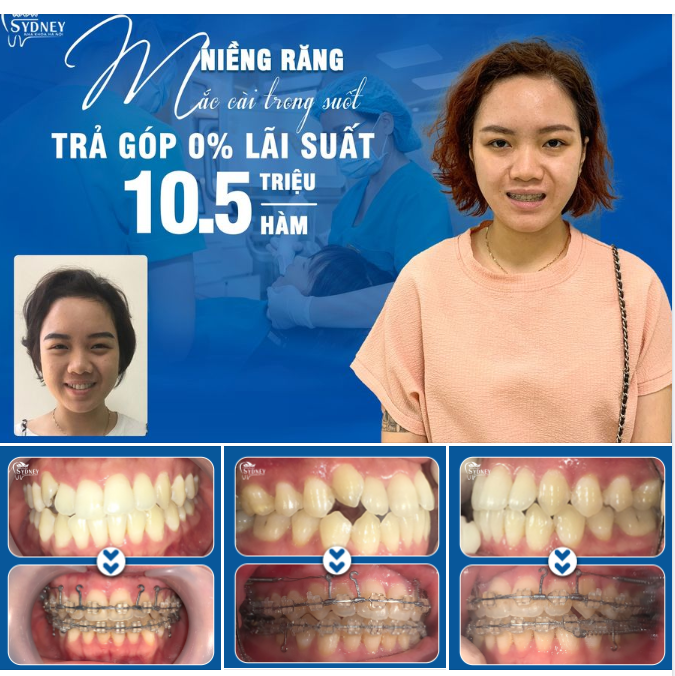 NIỀNG RĂNG TRONG SUỐT MANG LẠI THẨM MỸ CAO NHƯ THẾ NÀO?