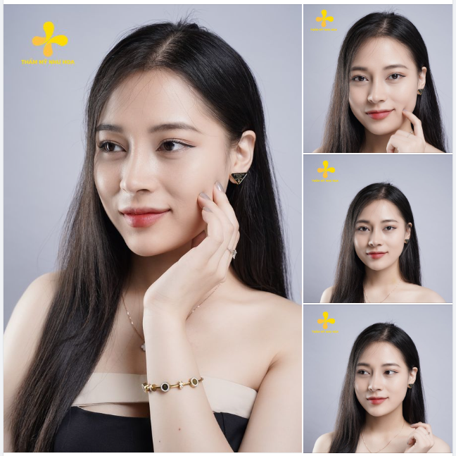 Cập nhật hình ảnh bạn Thu Thủy sau hơn 1 tháng nâng mũi cấu trúc.