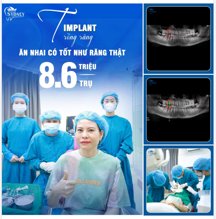 TRỒNG RĂNG IMPLANT CÓ THỰC SỰ TỐT KHÔNG?