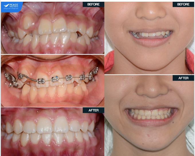 2 NĂM NIỀNG RĂNG LÀ TRẢI NGHIỆM RẤT THÚ VỊ