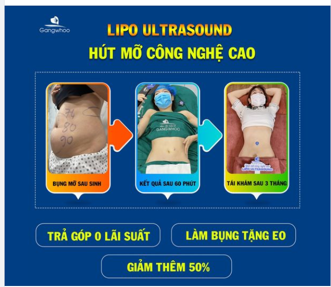 CHỌN LIPO ULTRASOUND - CHỌN XÓA XỔ BỤNG MỠ XỒ XỀ SAU SINH