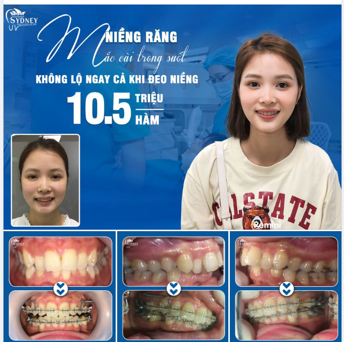 TẠI SAO NIỀNG RĂNG MẮC CÀI TRONG SUỐT LẠI “HOT” ĐẾN VẬY?