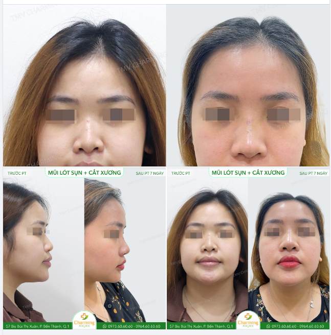 Công bằng mà nói thì sóng mũi của bạn khách này không hề thấp. Nhưng mỗi tội là chiếc xương nền mũi khá to, khiến cho góc nhìn trực diện của bạn gần như không thể nhìn thấy sóng mũi.