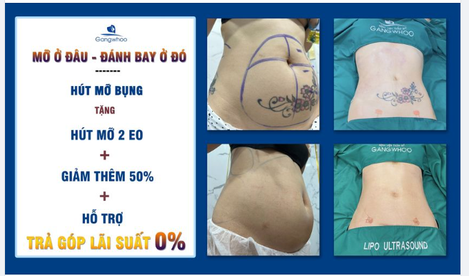 MỠ Ở ĐÂU - LIPO ULTRASOUND CŨNG ĐÁNH BAY ĐƯỢC!