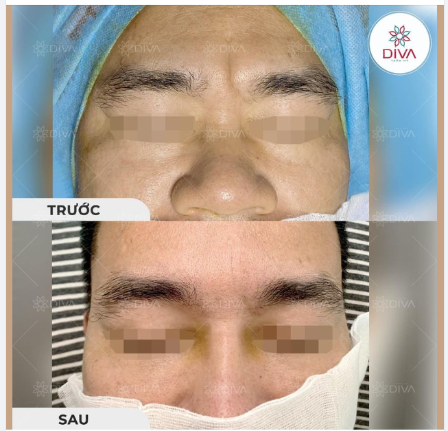 MŨI GÃY, NẾP NHĂN SÂU VÙNG GIAN MÀY PHƯƠNG PHÁP NÀO CẢI THỆN?