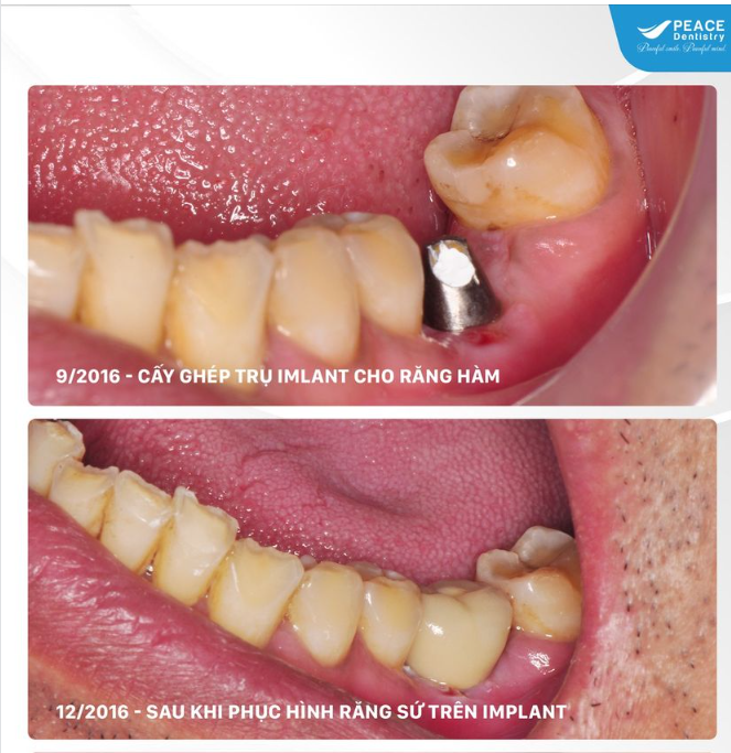 CẤY GHÉP IMPLANT - SỰ ĐẦU TƯ BỀN VỮNG CHO RĂNG MẤT