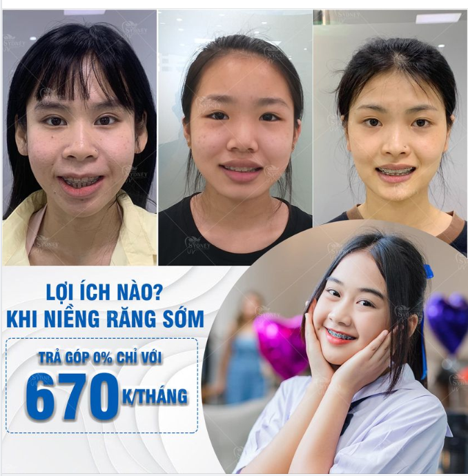 NIỀNG RĂNG CHO TRẺ - NIỀNG SỚM LỚN XINH