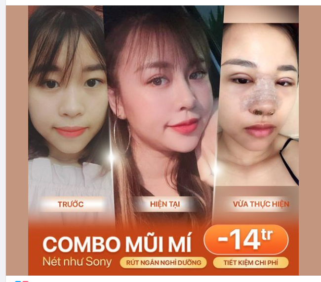 Đẹp toàn diện với sau 90 phút với combo NÂNG MŨI + CẮT MÍ