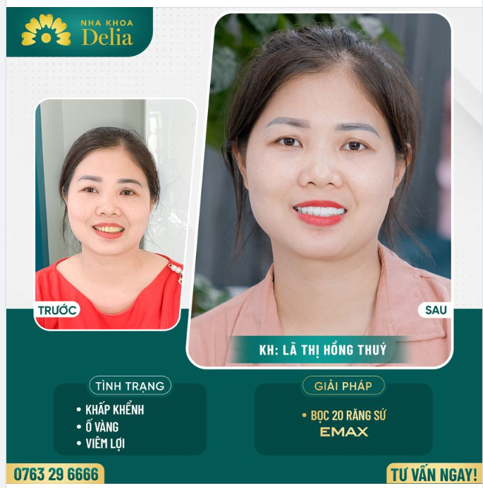 Xử lý răng khấp khểnh, ố vàng - Khách hàng tự tin khoe nụ cười rạng rỡ