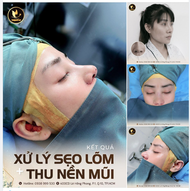 KẾT QUẢ: XỬ LÝ SẸO LÕM + THU NỀN MŨI CHO KHÁCH HÀNG VIỆT KIỀU MỸ