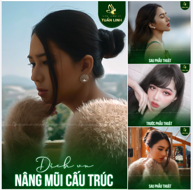 GƯƠNG MẶT THAY ĐỔI HOÀN TOÀN SAU NÂNG MŨI CẤU TRÚC