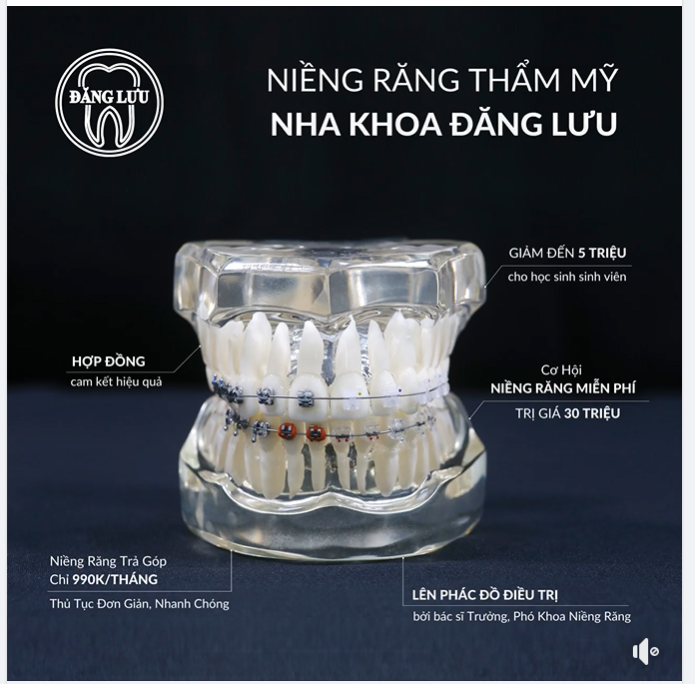 Cơ hội nhận ưu đãi niềng răng miễn phí trị giá đến 30 triệu đồng!