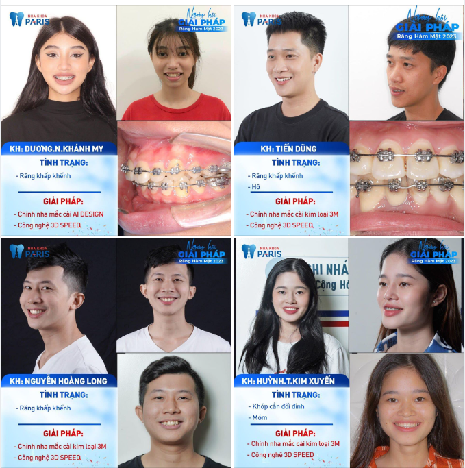Những màn thay đổi ngoạn mục nhờ niềng răng!