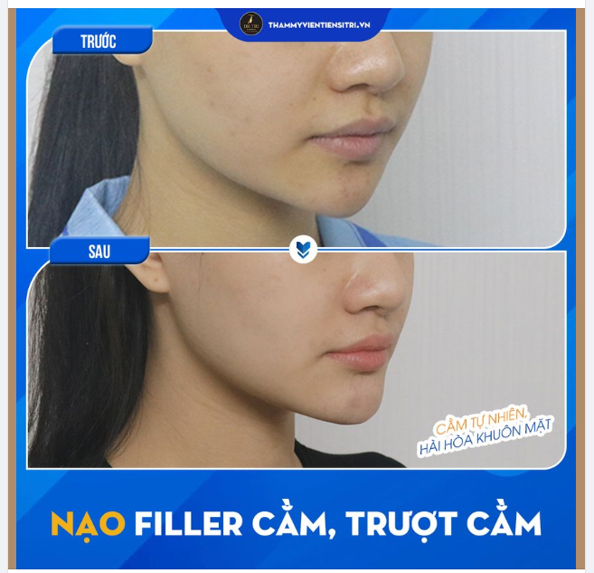 NẾU BẠN MUỐN CÓ DÁNG CẰM V-LINE TỰ NHIÊN MÀ BỀN VĨNH VIỄN  HÃY NHỚ TỚI TRƯỢT CẰM