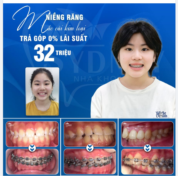 RÚT NGẮN THỜI GIAN NIỀNG RĂNG VỚI MẮC CÀI TỰ ĐỘNG